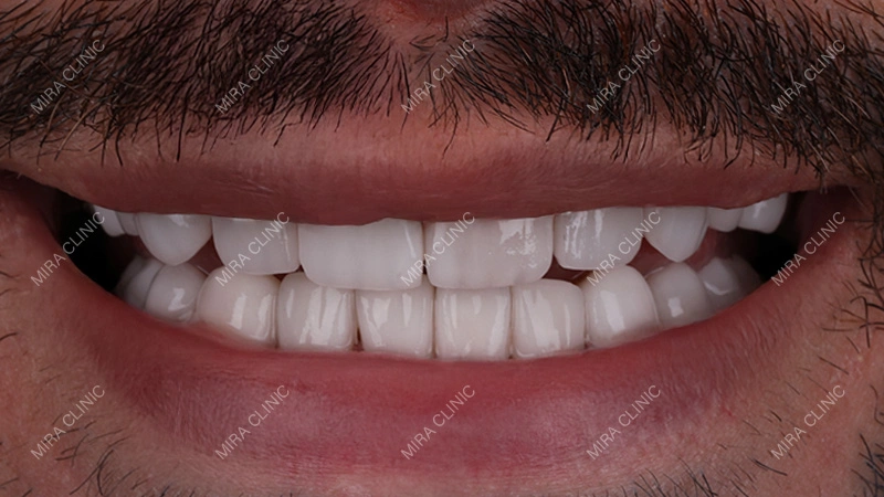 Zirconia Crowns